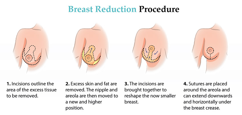 Breast Reduction Explained