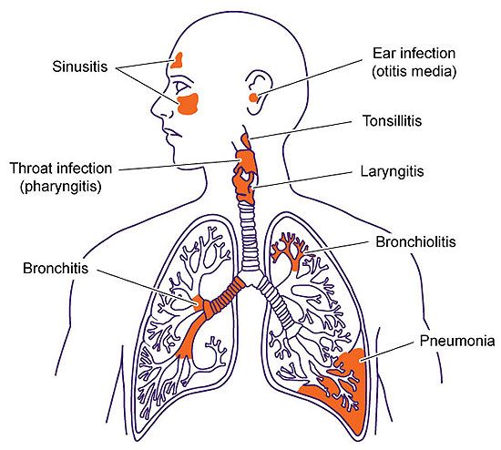 What are Lower Respiratory Infections